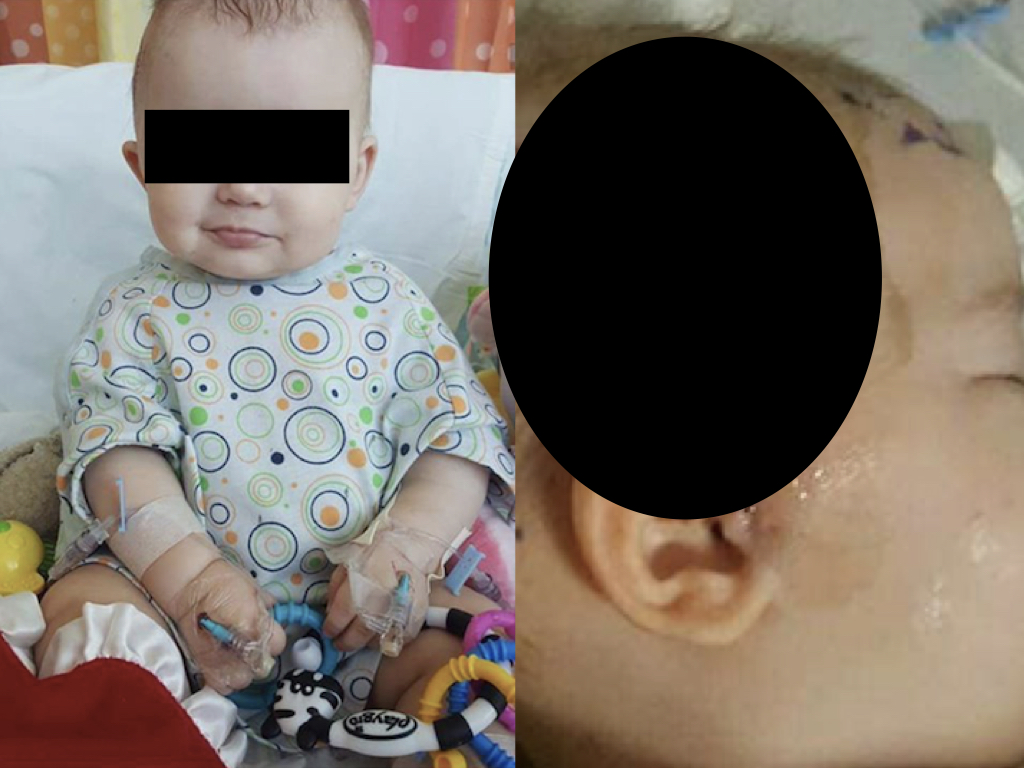 Le foto della bimba danneggiata dalla vitamina K e dai vaccini - Pericolosa disinformazione - foto1