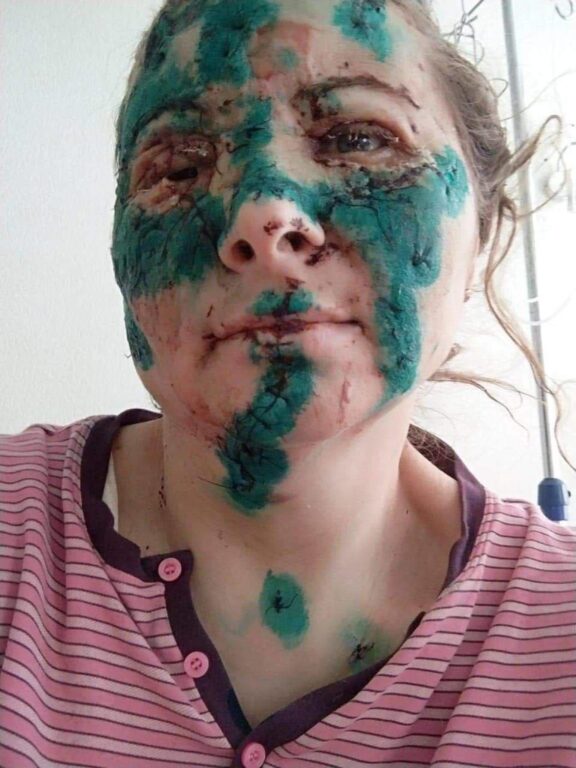 Nina Zhuk, farmacista ucraina sfigurata mentre lavorava