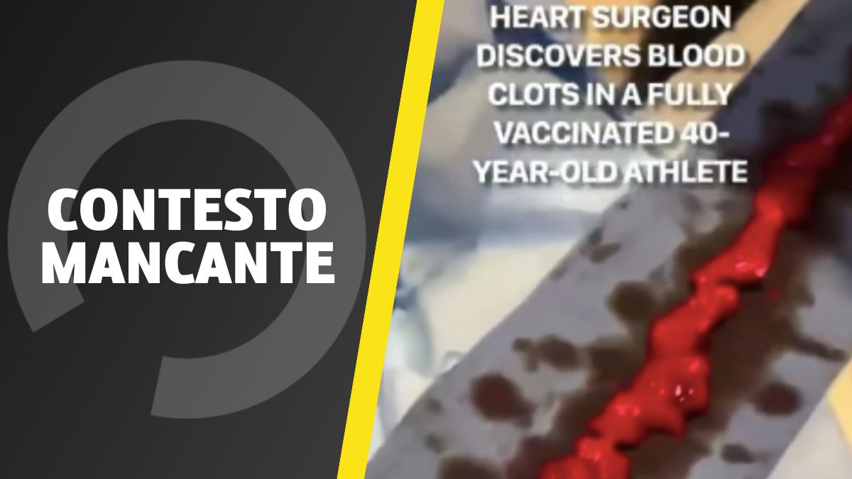 No! Questo video non dimostra la formazione di coaguli di sangue in un atleta di 40 anni vaccinato