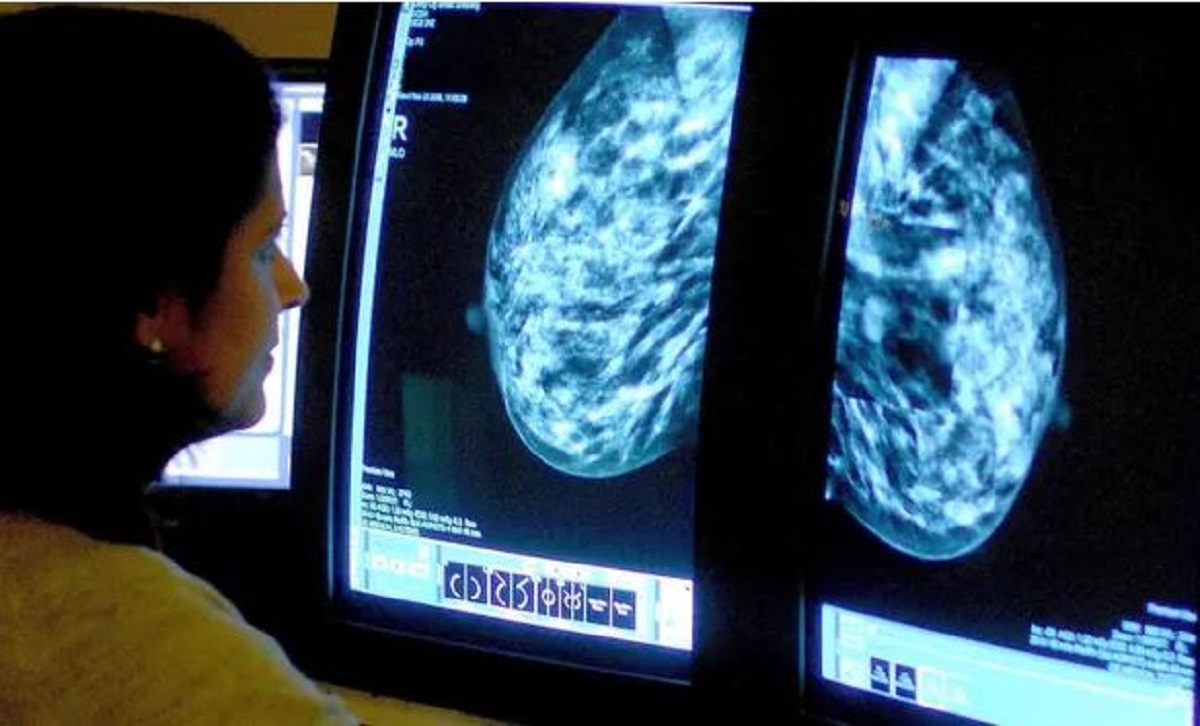 Tumore al seno, il nuovo farmaco che riduce del 25% il rischio di recidiva della forma più comune