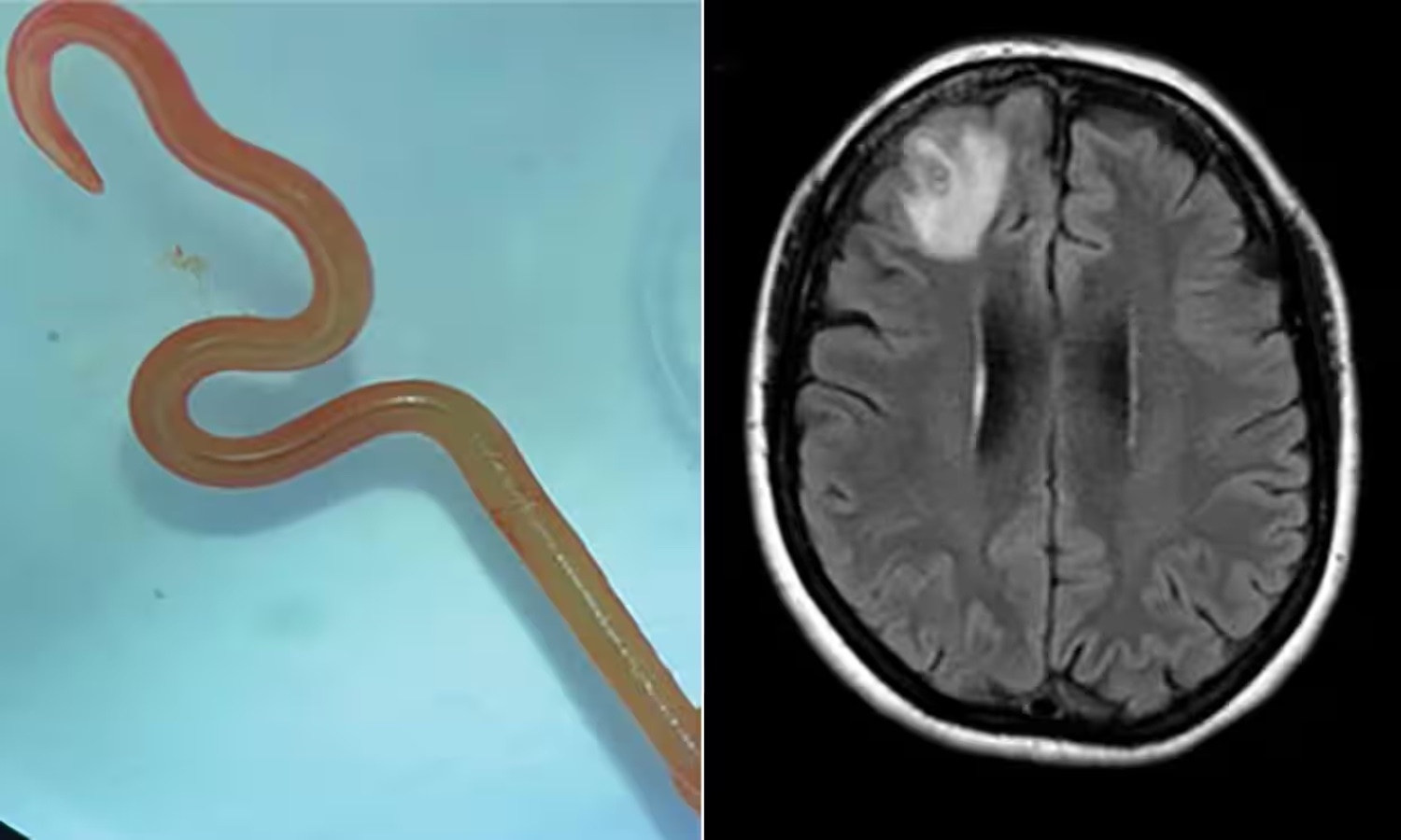 Caso de mujer con gusano parásito en su cerebro descubierto en Australia: ‘comúnmente encontrado en serpientes’