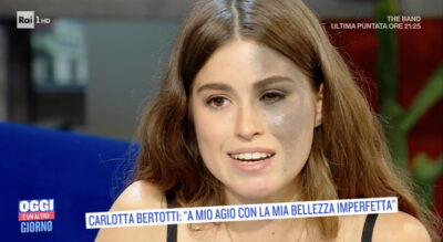 carlotta bertotti malattia nevo di ota