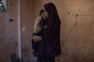 gaza-bambini-malnutriti-medico-intervista