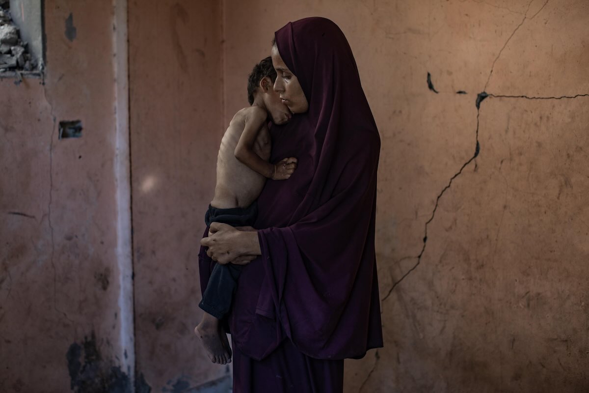 gaza-bambini-malnutriti-medico-intervista