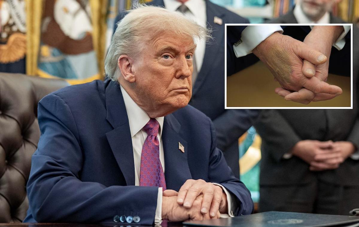 trump insufficienza venosa mano livido