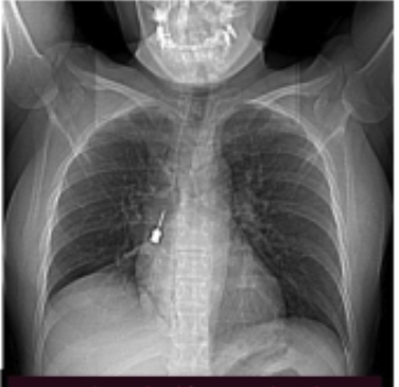 Cacciavite incastrato paziente Reggio Calabria