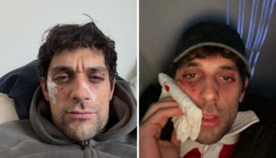 bresh ferito volto aggressione cane