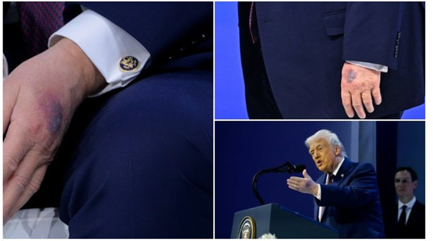 donald trump livido mano sinistra