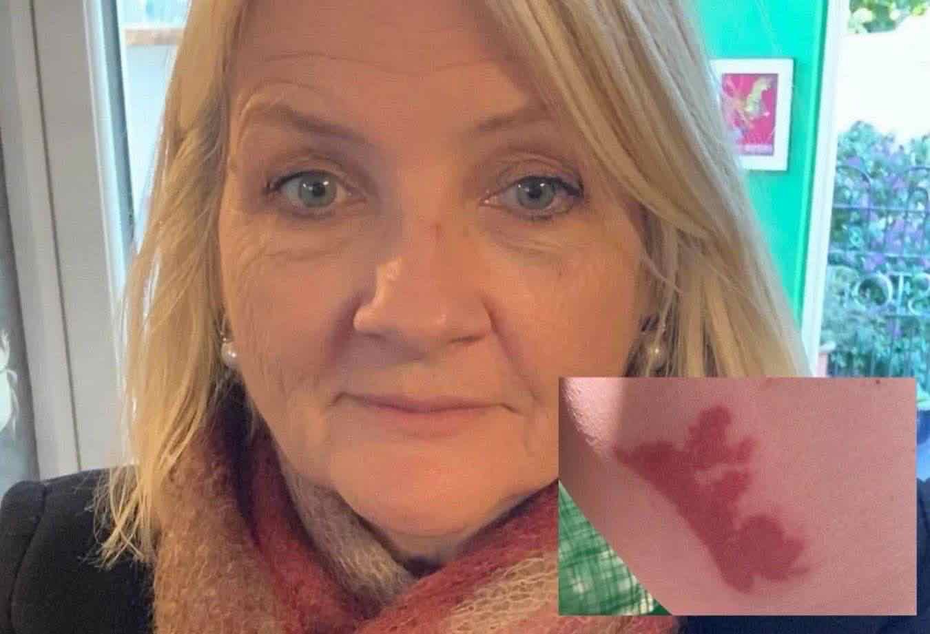 Ustionata volo Ryanair