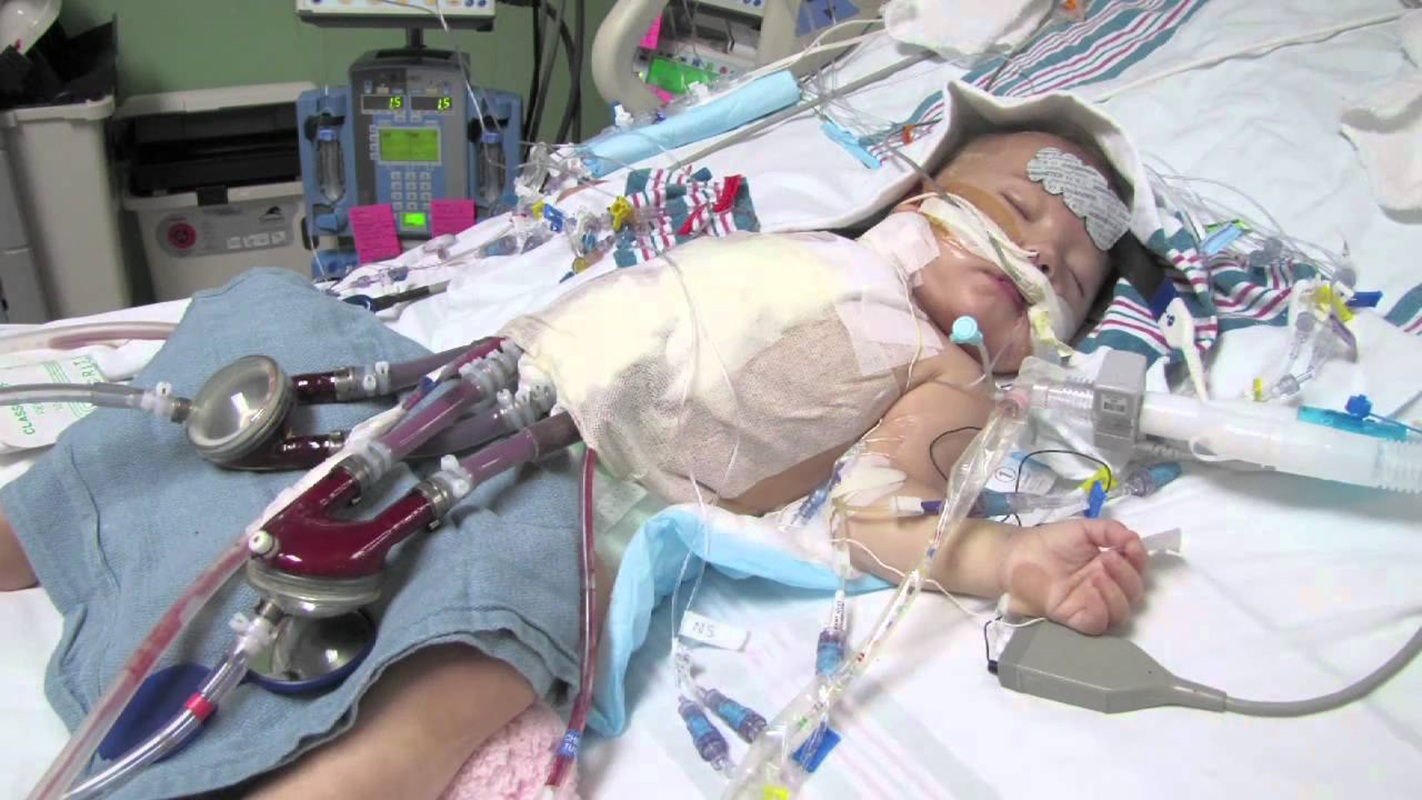 bimbo cuore bruciato cuore artificiale berlin heart stop terapie