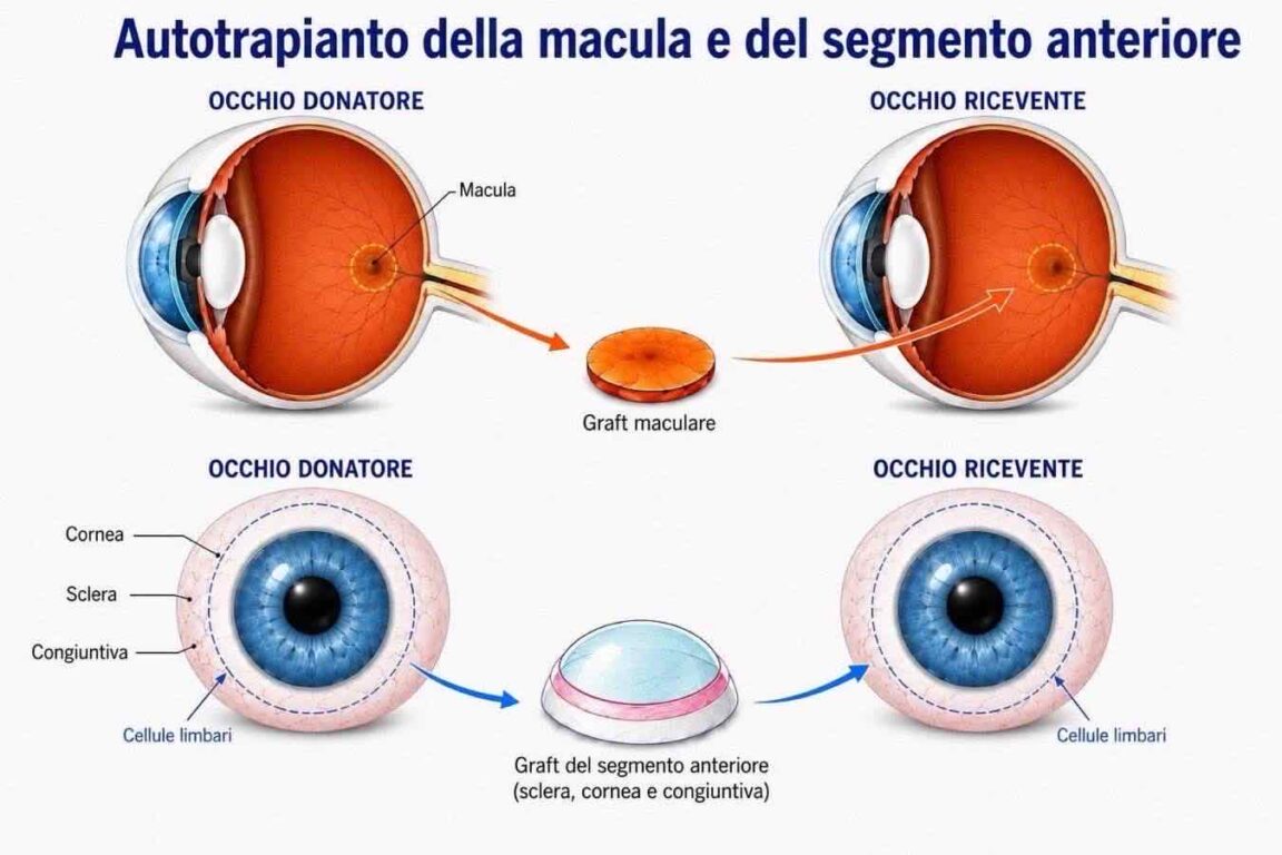 Come è stato eseguito l'autotrapianto oculare alle Molinette di Torino
